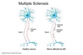 Multiple sclerosis research laboratory at mayo clinic. Treatment Options For Multiple Sclerosis