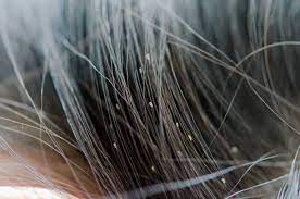 Getting rid of nits is about finishing the job. How To Get Rid Of Nits And Lice In Hair