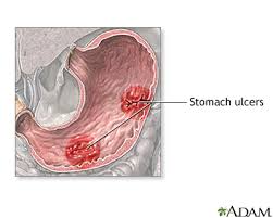 Stomach cancer, also known as gastric cancer, can affect any part of the stomach. Stomach Cancer Multimedia Encyclopedia Health Information St Luke S Hospital