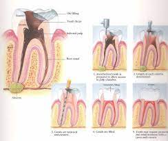 Skinny Tooth Implant Steps Dentistlife Toothimplantbeforeandafter Root Canal Root Canal Treatment Teeth Implants