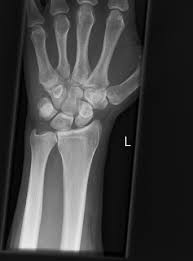 Image result for Scapholunate Dislocation