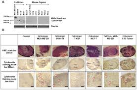 Breast cancer is most often genetically linked and caused by the growth of abnormal breast cells. Metastatic Breast Cancer Cells In Lymph Nodes Increase Nodal Collagen Density Scientific Reports