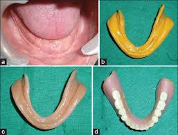 What is a permanent soft liner for a denture? Fabrication And Relining Of Dentures With Permanent Silicone Soft Liner A Novel Way To Increase Retention In Grossly Resorbed Ridge And Minimize Trauma Of Knife Edge And Severe Undercuts Ridges Singh K