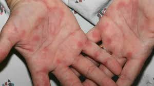 Itching also known as pruritus, is an uncomfortable, irritating sensation that it is characterized by sores in the mouth, and a painful rash on the hands and feet. Palm Rash 8 Common Causes And Treatment Options