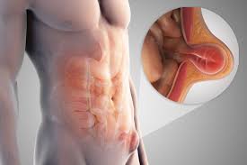 Learn How Men Get Different Types Of Hernias Hernia Symptoms Hernia Inguinal Umbilical Hernia
