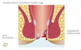 Analthrombose Analvenenthrombose Symptome Ursachen Behandlung Onmeda De