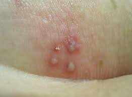 Herpes simplex type 2 is the most frequent cause of neonatal herpes, a very uncommon, but dangerous infection in newborns. Core Concepts Herpes Simplex Virus Genital Pathogen Based Diseases National Std Curriculum