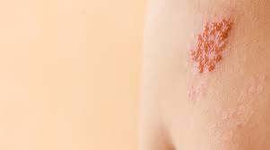 Image result for shingles