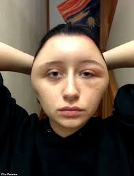 Zoe diana draelos, a clinical and research. Woman S Head Puffed Up After Allergic Reaction To Hair Dye 9gag