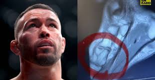 Colby Covington Reveals NEW X-Ray of Broken Foot From UFC 296, Targets Ian  Garry & Others Next!