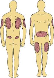 Do not use lantus to treat diabetic ketoacidosis. Full Size Picture Insulin Injection Sites Jpg