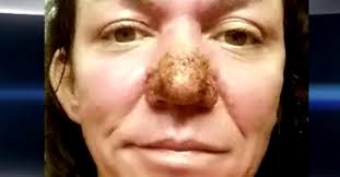 Das rhinophym kann infolge eines fortgeschrittenen stadiums der. Frau Mit Seltener Hauterkrankung Bekommt Neue Nase Geschenkt