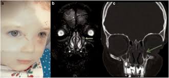 Pseudodacryocystitis: paediatric case series of infected atypical ethmoid  air cells masquerading as recurrent dacryocystitis