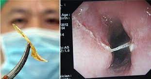 Tapi, cara ini tak juga berkesan, tulang ikan tersebut masih lagi terlekat pada tekak. Bahaya Guna Jari Doktor Kongsi Langkah Yang Perlu Buat Kalau Tercekik Tulang Maskulin