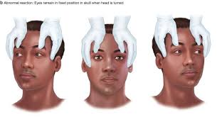 Image result for Oculovestibular Testing