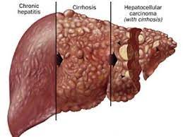 Namun, sebelum menyimpulkan perbedaan antara penyakit kuning dan hepatitis a, sepertinya penting untuk menyimak pembahasan mengenai keduanya berbeda dengan penyakit kuning, hepatitis a adalah penyakit yang menyerang hati, akibat adanya infeksi virus hepatitis a (hav). Sirosis Hati Dan Hepatitis Apa Bedanya Prosehat