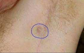 Petite Boule Sous L Aisselle Ingrownhairneck Ingrownhaironlegs Ingrown Hair Armpit Lump Armpits