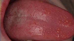 Por Que Nos Salen Granos En La Lengua Mujer De 10 Guia Real Para La Mujer Actual Enterate Ya Granos Alergias Agua Con Bicarbonato