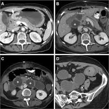 A 72-year-old female with distal gastric carcinoma (thick arrow) as...
