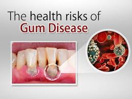 The State Of Your Teeth Affects Your Overall Health With Gum Disease Linked To Lots Of Health Problems In Other Parts Gum Disease Gum Disease Treatment Dental