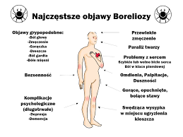 Borelioza to choroba zakaźna, której objawy obejmują skórę, stawy, układ nerwowy i serce. Choroba Z Lyme Borelioza