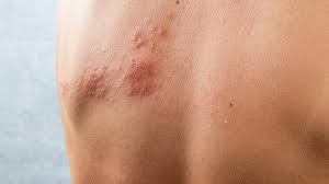 Image result for zoster under breasts