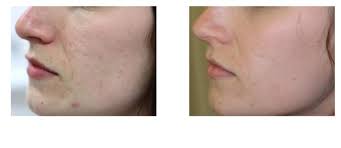Narbenredution Akne Therapie Laseraesthetik Berlin Mitte