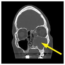 Image result for Sinus CT