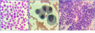 Maybe you would like to learn more about one of these? Pdf A Cytological Study To Differentiate Between Reactive Mesothelial Cells And Malignant Cells In Effusions Semantic Scholar