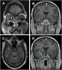 Box 599 bunkie, la 71322. Trigeminal Hypertrophic Interstitial Neuropathy Presenting As Unilateral Proptosis Ptosis Tearing And Facial Neuralgia Sciencedirect