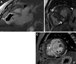 Image result for Cardiac MRI