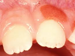 Tab enzomac plus twice daily for 3 days. Gum Boils What They Are And How To Treat Them