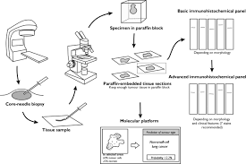 Learn more about types of lung cancer, survival rates, and other statistics. 2018 Consensus Statement By The Spanish Society Of Pathology And The Spanish Society Of Medical Oncology On The Diagnosis And Treatment Of Cancer Of Unknown Primary Springerlink