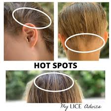 Discover 17 Common Head Lice Symptoms With Pictures And Find Out The Early And Late Signs Of Lice And Use These Fool Proof Ways In 2020 Head Louse Louse Hair Sensation