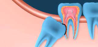 Check spelling or type a new query. Oral Surgery Affordable Wisdom Tooth Extraction Dr Sonia Sharma