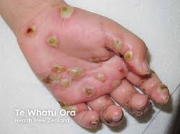 Image result for scabies human bites