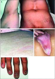 Image result for Ichthyosis