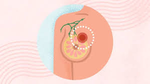 Image result for Breast Cancer