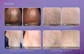 But hair grows in cycles, and the lasers only damage follicles during an active cycle of hair growth. Permanent Laser Hair Removal Newport Medical And Wellness Center