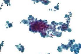 The median survival of a peritoneal mesothelioma patient is about 31 months. Peritoneal Mesothelioma Wikipedia
