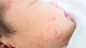 Bintik merah pada kulit (red spot on skin) adalah? Ruam Merah Pada Bayi Apakah Tanda Alergi Info Sehat Klikdokter Com