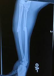 Check spelling or type a new query. Before And After Of Surgery For Broken Arm Album On Imgur