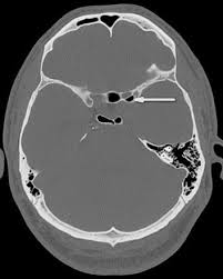Sphenoethmoidal Air Cell Radiology Reference Article Radiopaedia Org Radiology Cell Internal Carotid Artery