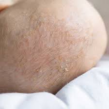 Image result for Cradle Cap