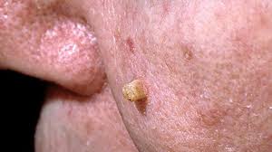 The main difference to note is that these bumps will not feel soft like a pimple, but rather will be firm or hard to the touch. Skin Cancer Rash Itchiness And Symptoms