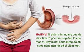 665 likes · 436 talking about this. Viem Hang Vá»‹ Dáº¡ Day La Gi Nguyen Nhan Triá»‡u Chá»©ng Bá»‡nh