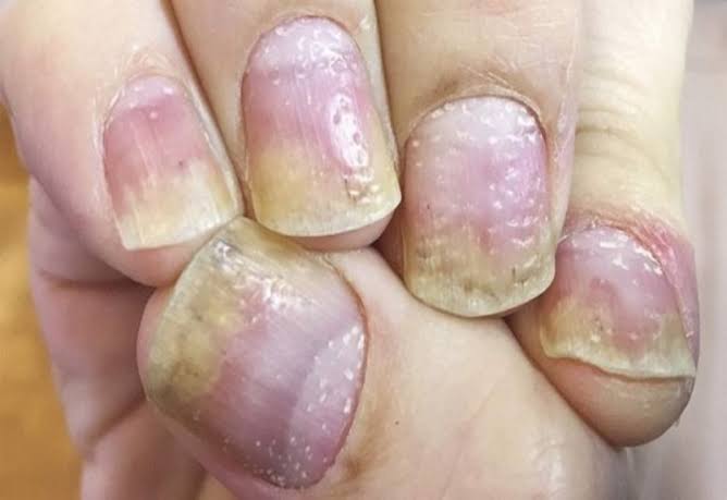 Móng tay bị rỗ do những nguyên nhân nào?