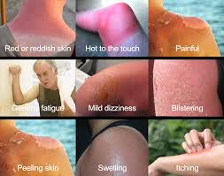 Image result for Sunburn