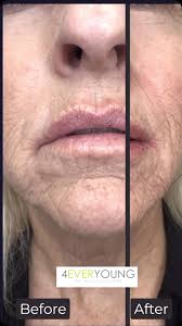 Lips 👄 and sulcus! , Try and look at each line and how it changes with  filler ! Trying to erase smoker lines around mouth with deep volume  replenishment and superficial volume! , ., Free Consultations ...