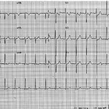 Ajr) = due to ajr with aberrant conduction may be difficult to distinguish from accelerated idioventricular rhythm. Sustained Accelerated Junctional Rhythm Without Atrioventricular Download Scientific Diagram
